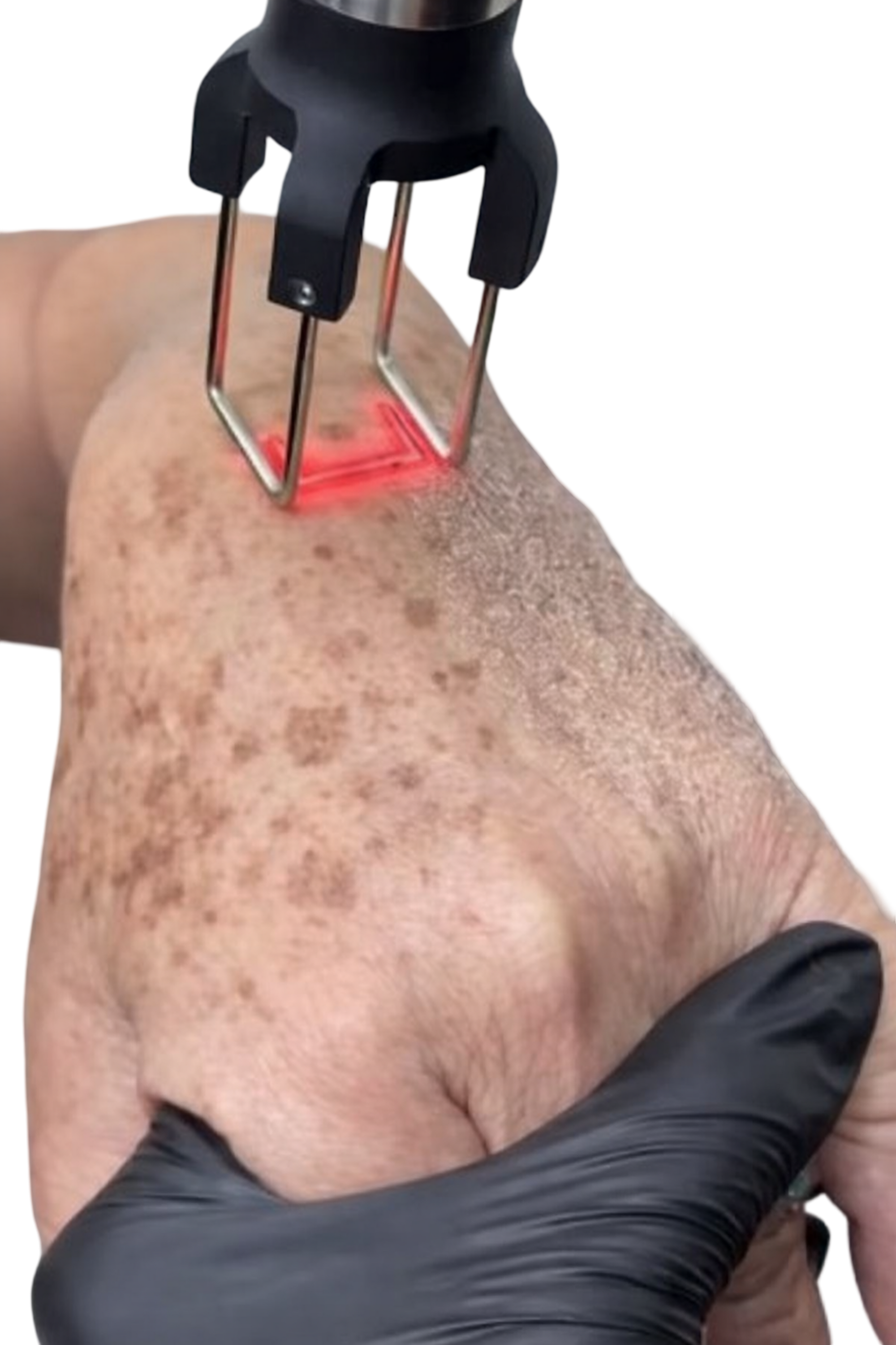 CO2 FRACTIONAL LASER - HAND REJUVENATION