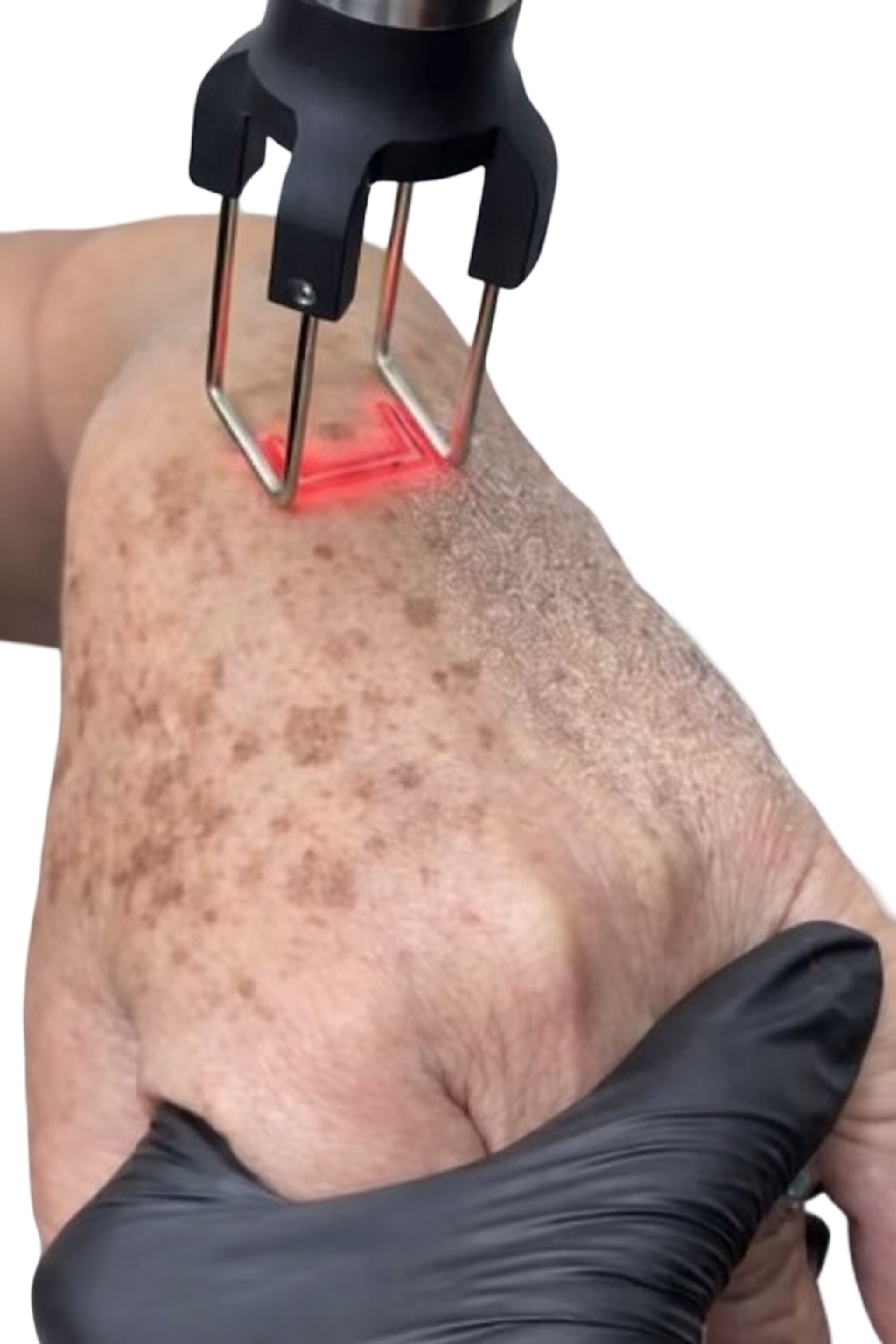 CO2 FRACTIONAL LASER - HAND REJUVENATION