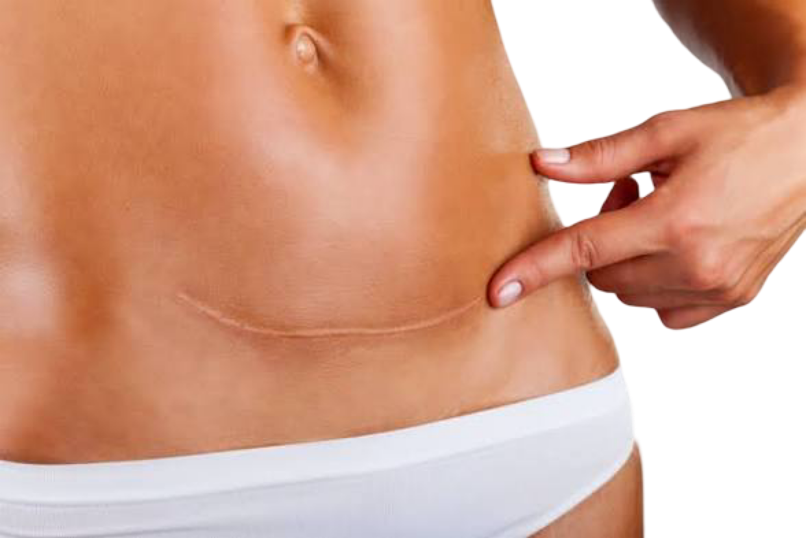 CO2 FRACTIONAL LASER - SURGICAL & TRAUMATIC SCARS