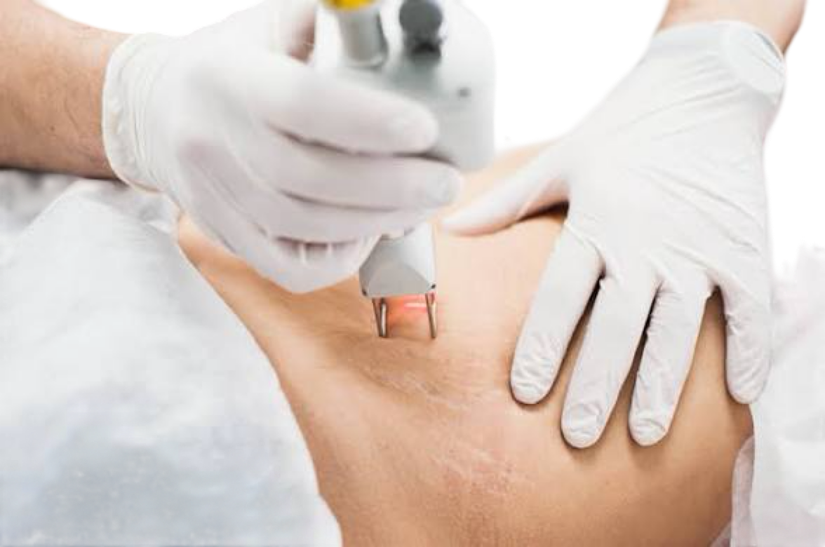 CO2 FRACTIONAL LASER - STOMACH STRETCH MARKS