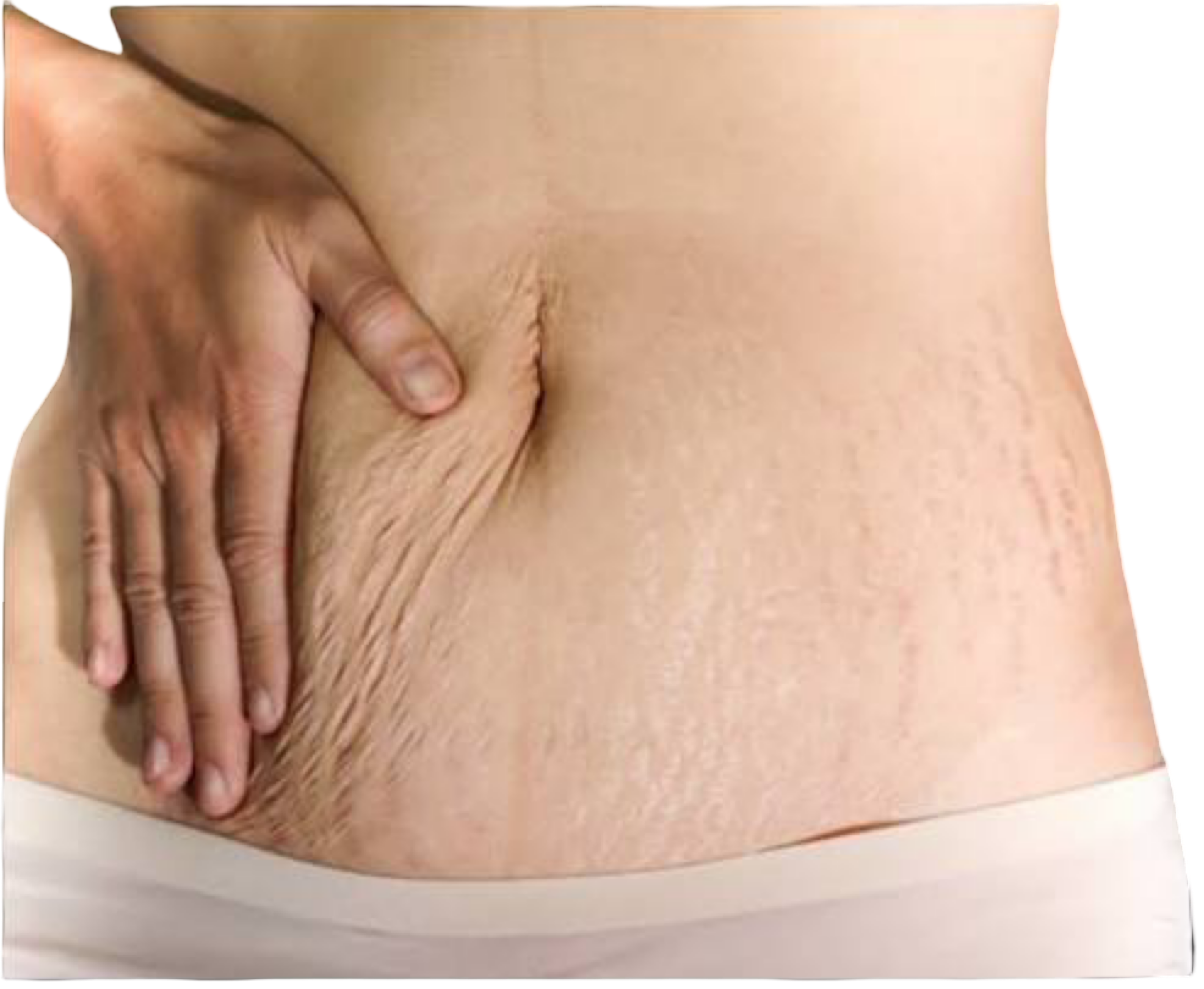 CO2 FRACTIONAL LASER - STOMACH SKIN TIGHTENING