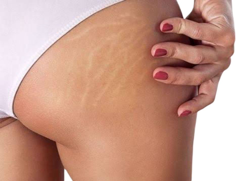 CO2 FRACTIONAL LASER - BUTTOCKS STRETCH MARKS