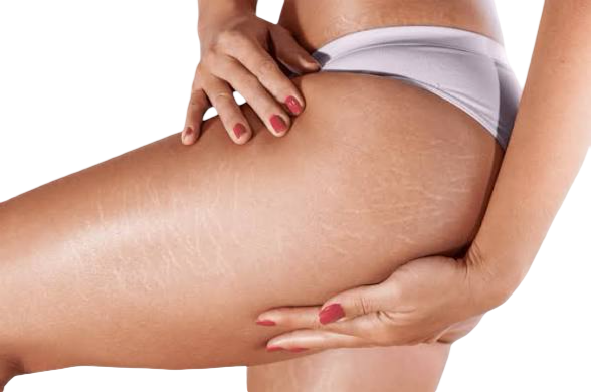 CO2 FRACTIONAL LASER - LEGS/ARMS STRETCH MARKS