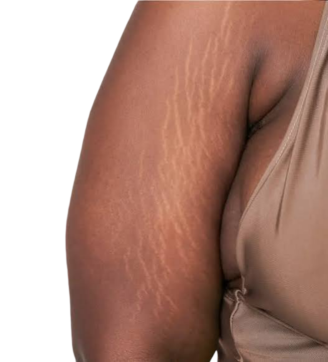 CO2 FRACTIONAL LASER - LEGS/ARMS STRETCH MARKS