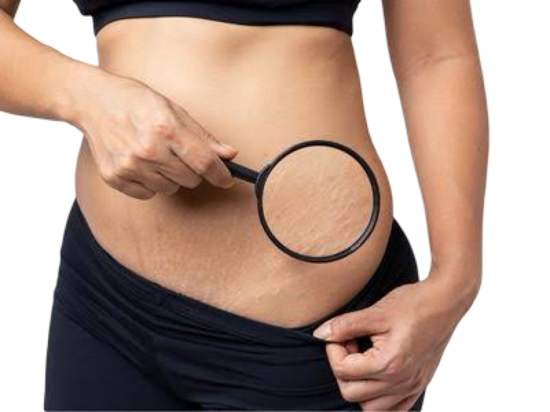 CO2 FRACTIONAL LASER - STOMACH STRETCH MARKS