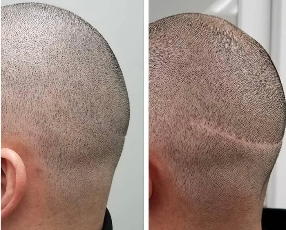 Scar Camouflage - Procedure Deposit