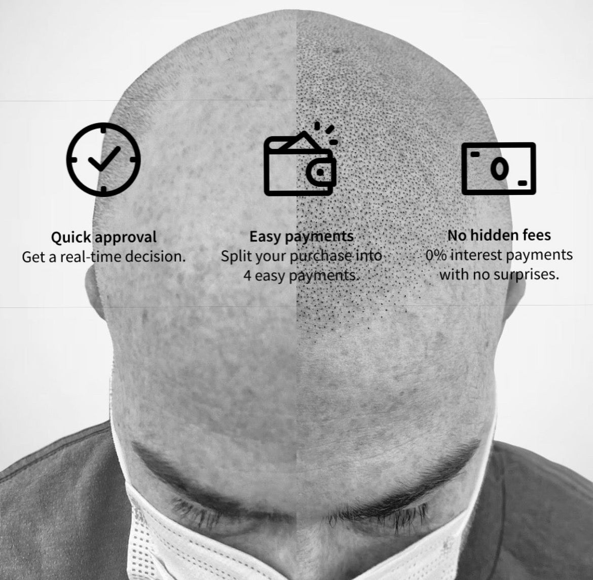 Scalp Micropigmentation (SMP) - Procedure Deposit