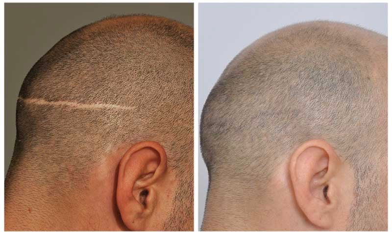 Scar Camouflage - Procedure Deposit