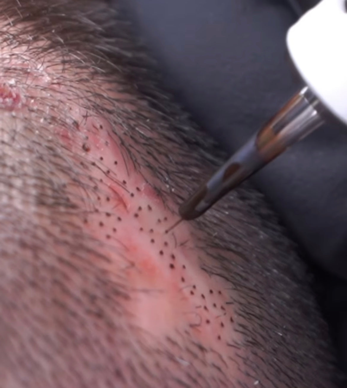 Scar Camouflage - Procedure Deposit