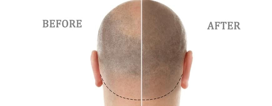 Scalp Micropigmentation (SMP) - Procedure Deposit