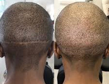 Scar Camouflage - Procedure Deposit